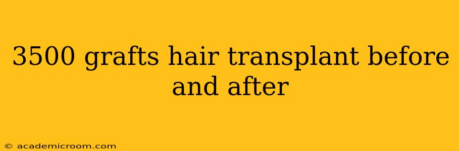 3500 grafts hair transplant before and after