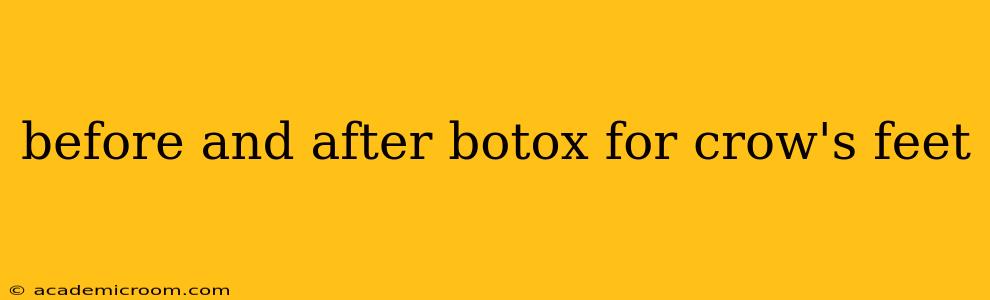 before and after botox for crow's feet