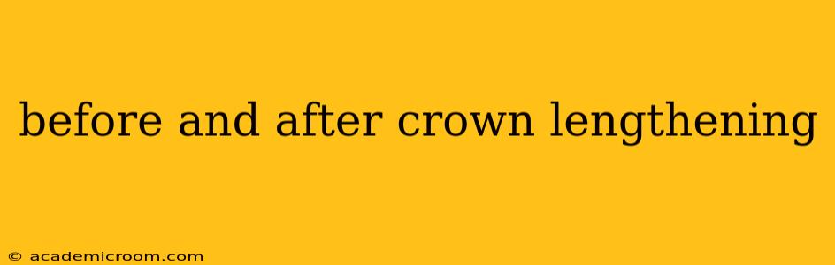 before and after crown lengthening