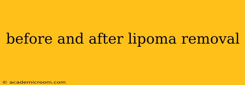 before and after lipoma removal