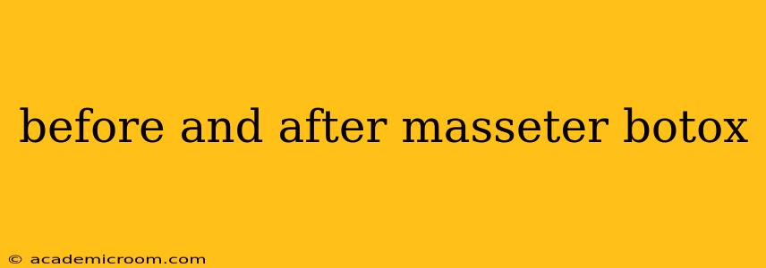 before and after masseter botox