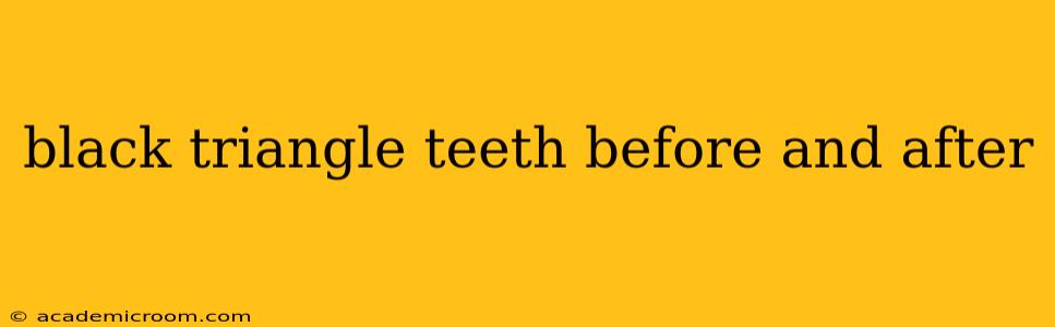 black triangle teeth before and after
