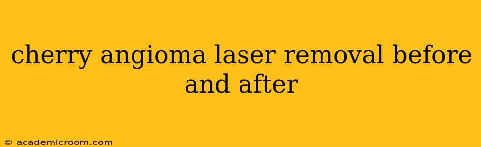 cherry angioma laser removal before and after