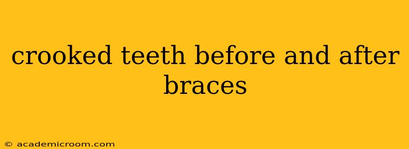 crooked teeth before and after braces