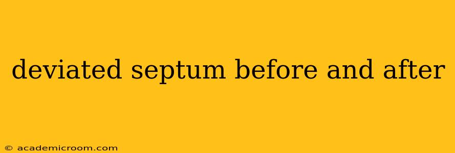 deviated septum before and after