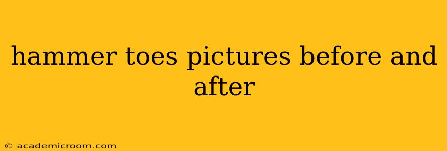 hammer toes pictures before and after