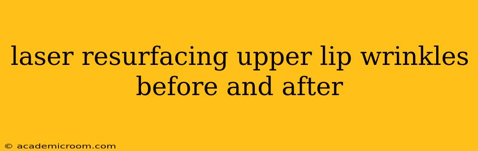 laser resurfacing upper lip wrinkles before and after
