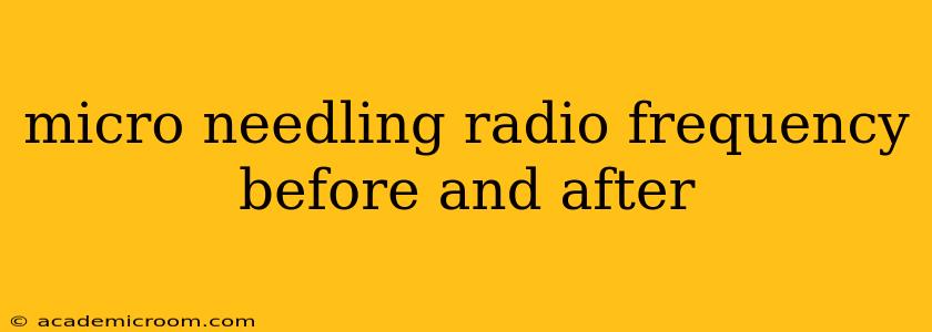micro needling radio frequency before and after