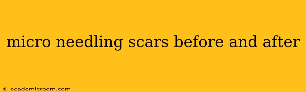 micro needling scars before and after