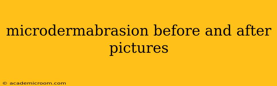 microdermabrasion before and after pictures