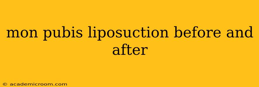 mon pubis liposuction before and after