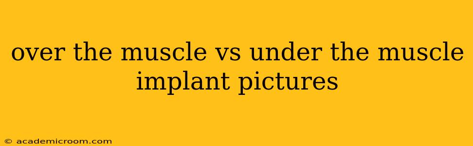 over the muscle vs under the muscle implant pictures