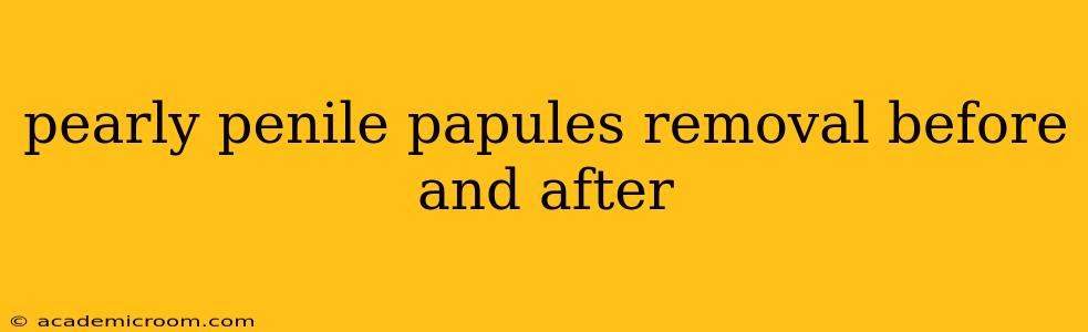 pearly penile papules removal before and after