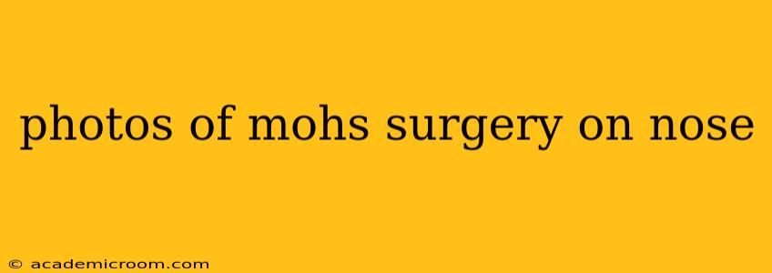 photos of mohs surgery on nose
