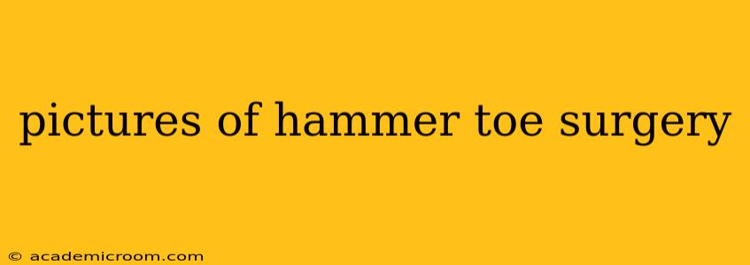 pictures of hammer toe surgery
