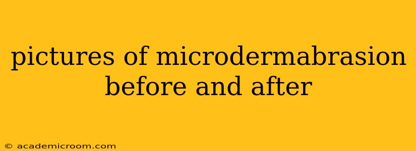pictures of microdermabrasion before and after
