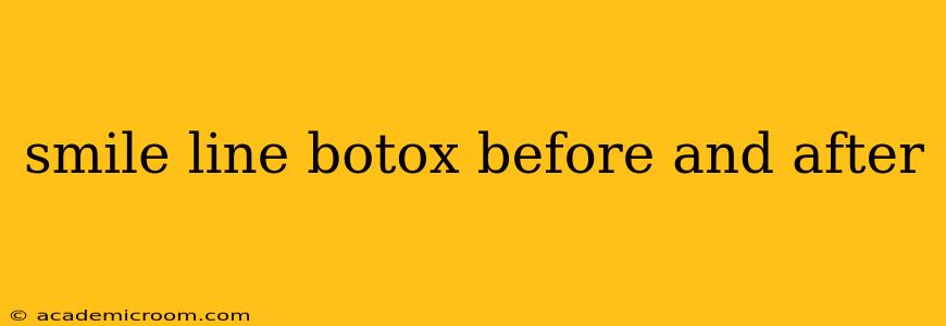 smile line botox before and after