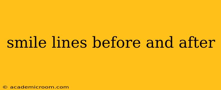 smile lines before and after
