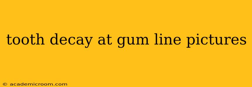 tooth decay at gum line pictures