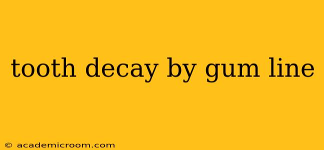 tooth decay by gum line