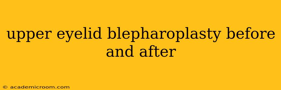 upper eyelid blepharoplasty before and after