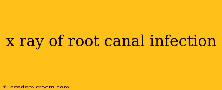 x ray of root canal infection